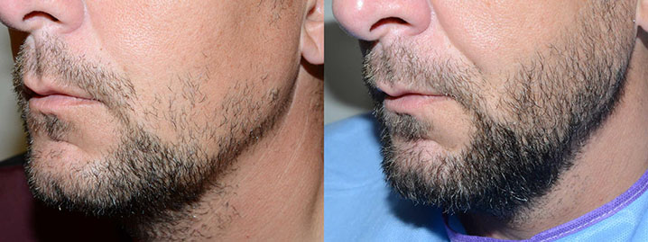 Сколько стоит пересадка бороды. Борода после пересадки. Трансплантация бороды. Пересадка бороды до и после.